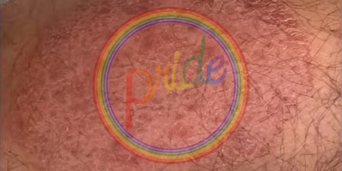‘Pride’ Month Features U.S. Debut of New Sexually Transmitted Ringworm